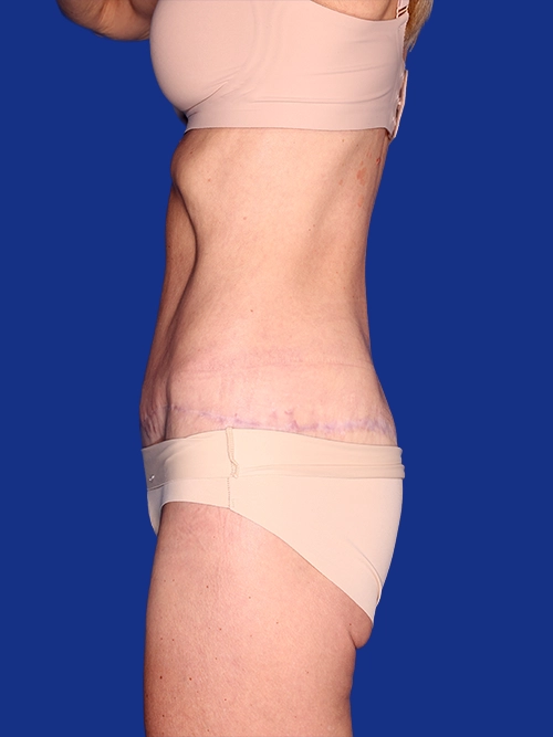 Abdominoplasty