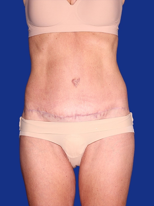 Abdominoplasty