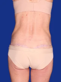 Abdominoplasty