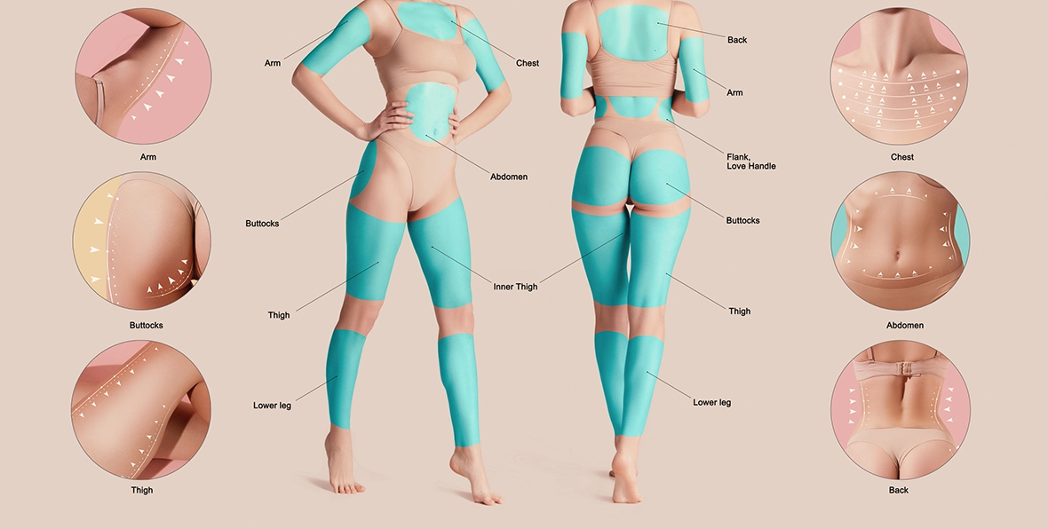 Body anatomy diagram showing liposuction treatment areas including abdomen, flanks, thighs, buttocks, arms, chest and back