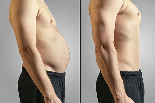 Before and after liposuction showing abdominal fat reduction results
