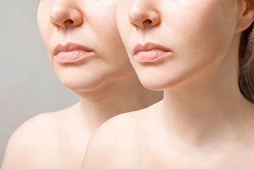 Before and after comparison of neck and jawline definition following liposuction