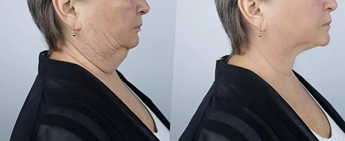 Neck liposuction before and after results showing improved jawline definition