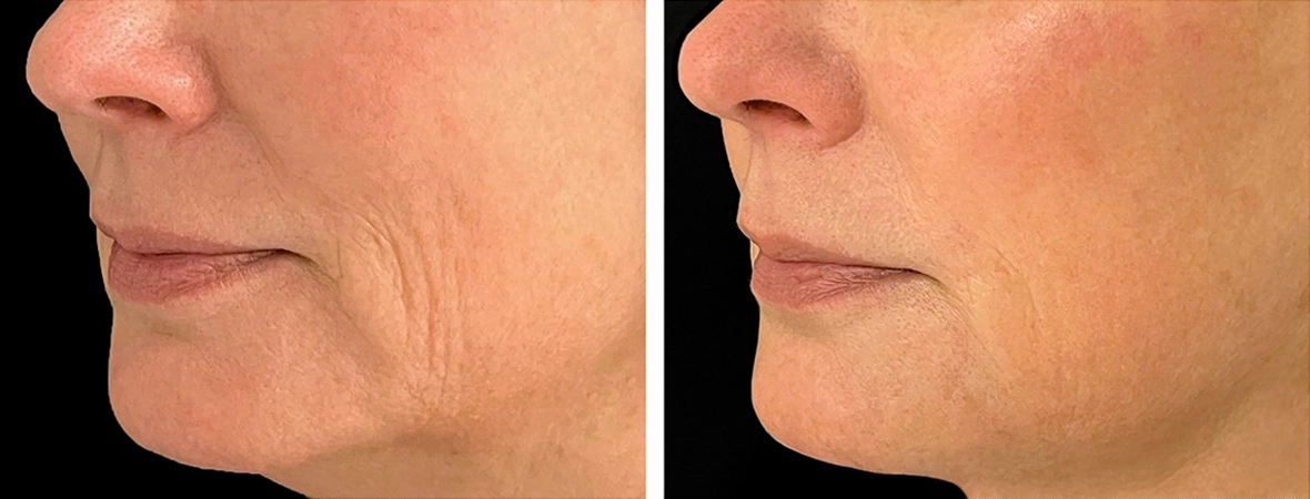 ellacor Before and After
