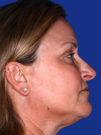 Brow Lift