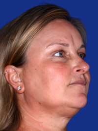 Brow Lift