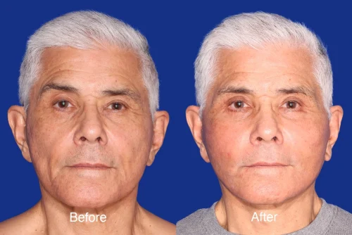 Fat Grafting Before and After