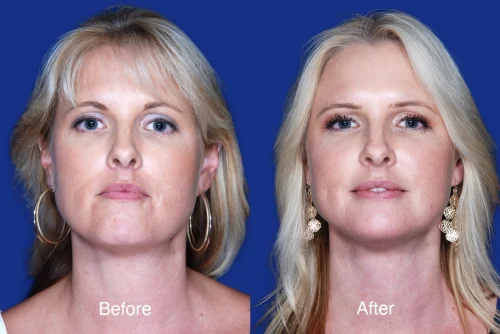 Neck Lift Before and After