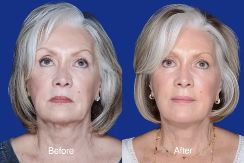 Facelift Before and After
