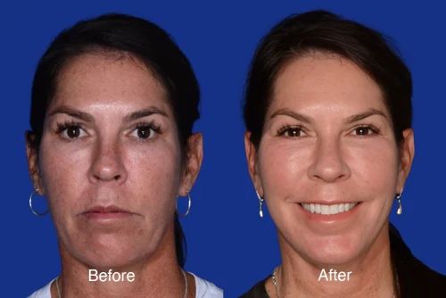 Laser Resurfacing Before and After
