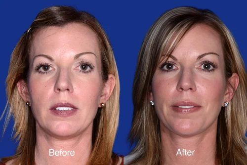 Blepharoplasty Before and After