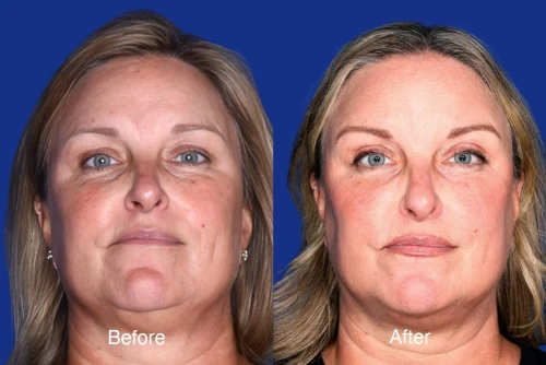 Brow Lift Before and After