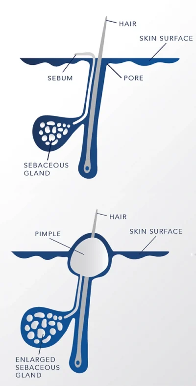 Diagram showing hair follicle and sebaceous gland anatomy, comparing normal and enlarged glands in acne formation