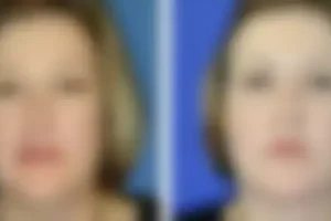 eyelid-lift-blur-1