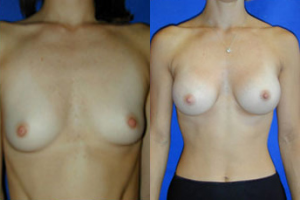 Patient 2 - Before and After